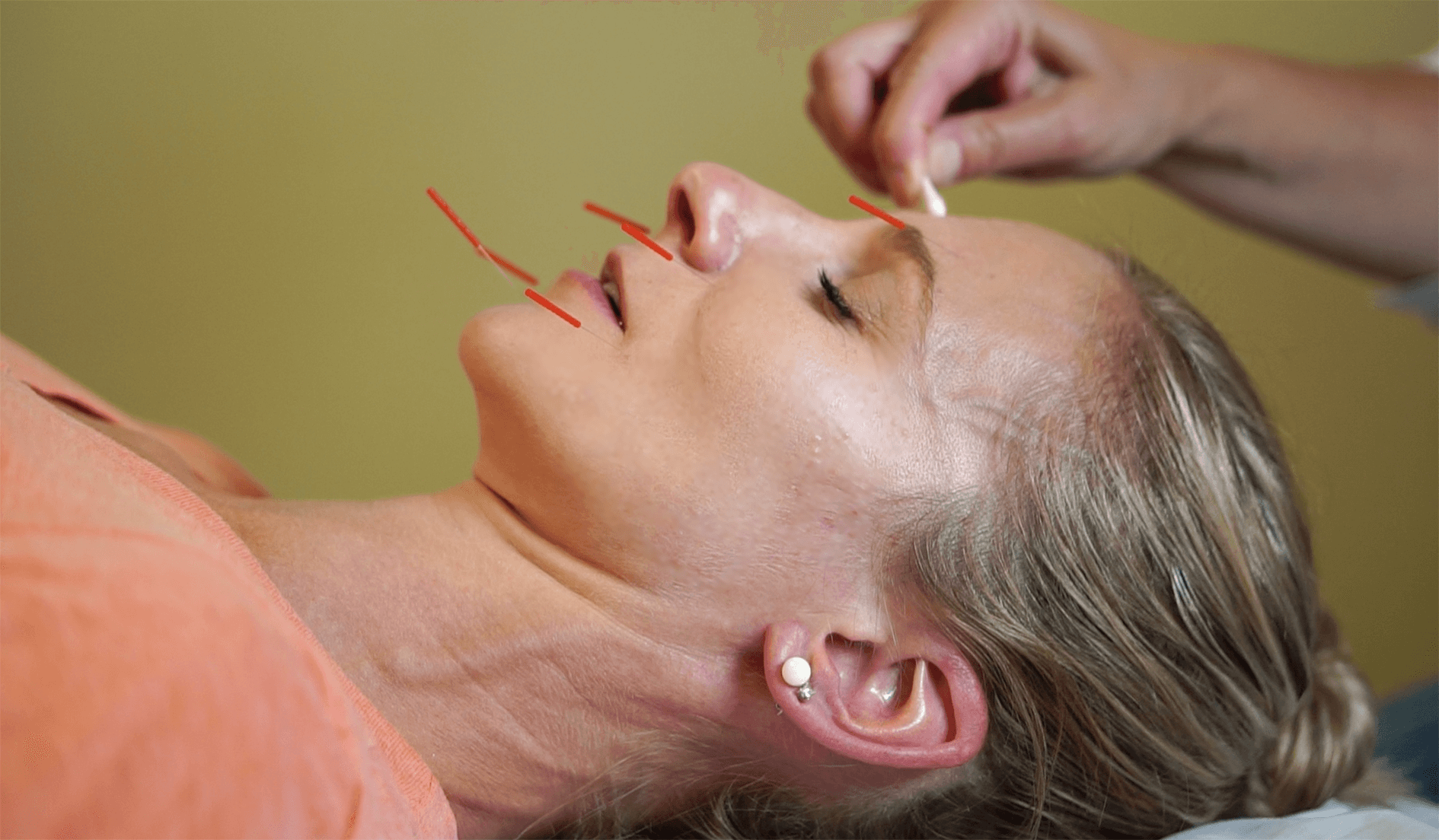 COSMETIC AC COSMETIC Acupuncture