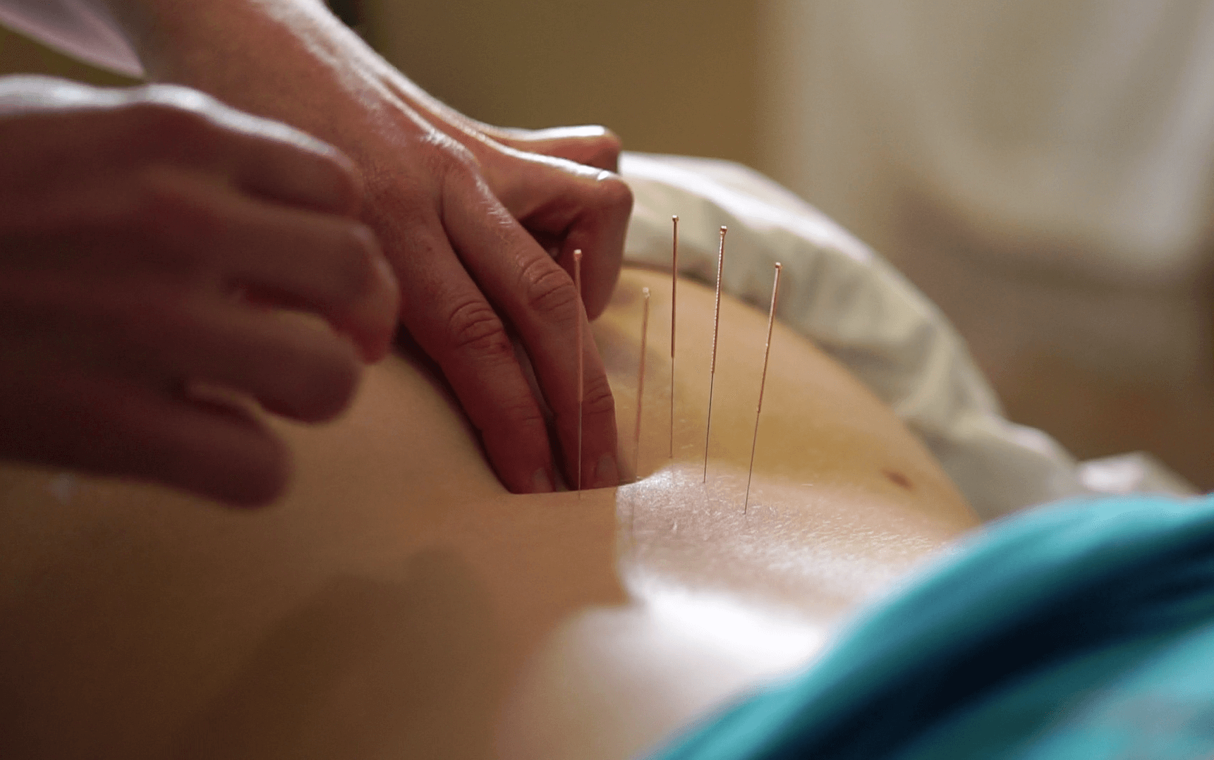 acupuncture acupuncture near me