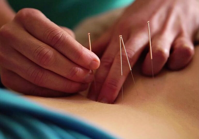 acupuncture near me