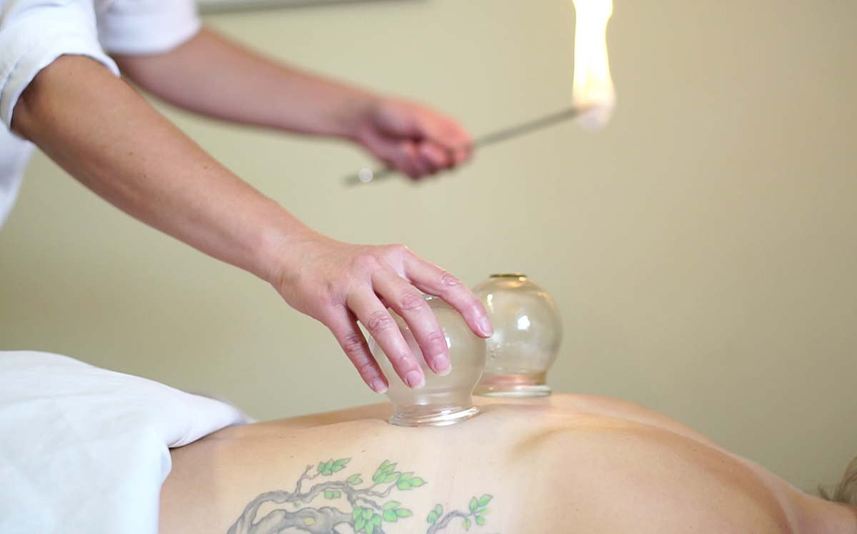 cupping near me